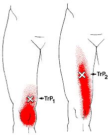 膝の痛み　内側