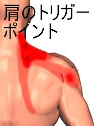 肩のトリガーポイントの図