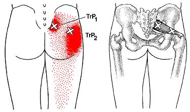 股関節の痛みトリガーポイント図